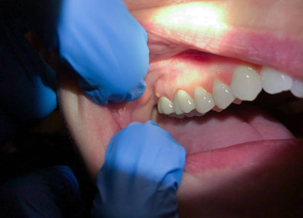 Best Knocked-Out Tooth Emergency  in Rainbow, CA